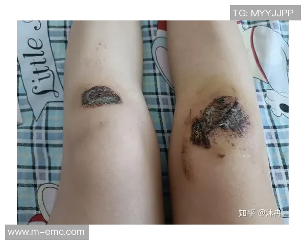 膝盖受伤影响足球运动的恢复与预防措施探讨